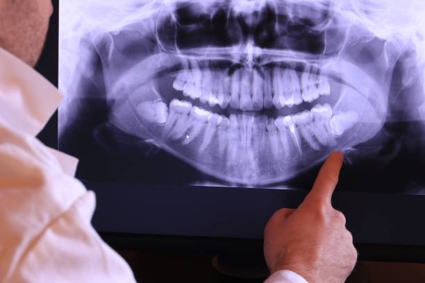 Best Emergency Dentist for Lost Fillings or Crowns in Grayson, GA